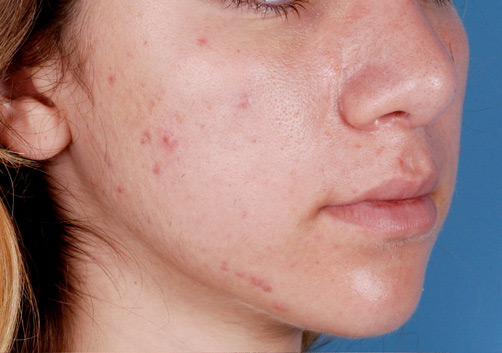 Patient 10 before photo of Acne Scars patient at Sensational Skin Scottsdale