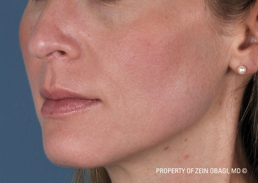 Patient 20 after photo of ZO Skin Health patient at Sensational Skin Scottsdale
