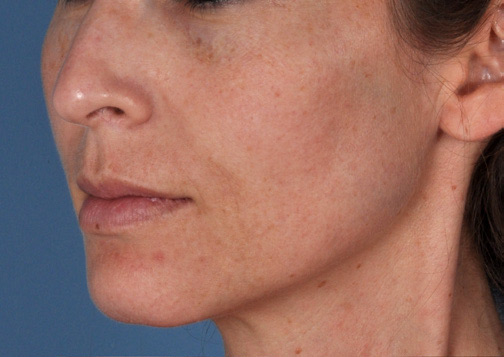 Patient 20 before photo of ZO Skin Health patient at Sensational Skin Scottsdale
