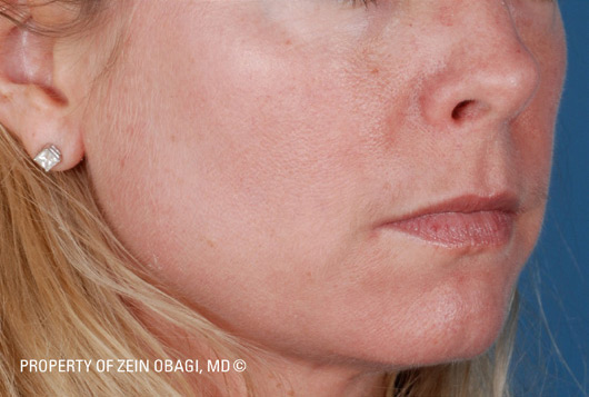 Patient 2 after photo of Sun Damage patient at Sensational Skin Scottsdale