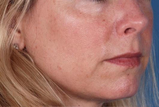 Patient 2 before photo of Sun Damage patient at Sensational Skin Scottsdale