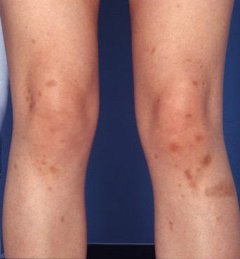 Patient 37 before photo of ZO Skin Health patient at Sensational Skin Scottsdale