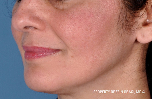 Patient 2 after photo of Rosacea patient at Sensational Skin Scottsdale