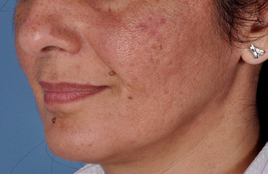 Patient 2 before photo of Rosacea patient at Sensational Skin Scottsdale