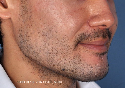 Patient 3 after photo of Rosacea patient at Sensational Skin Scottsdale