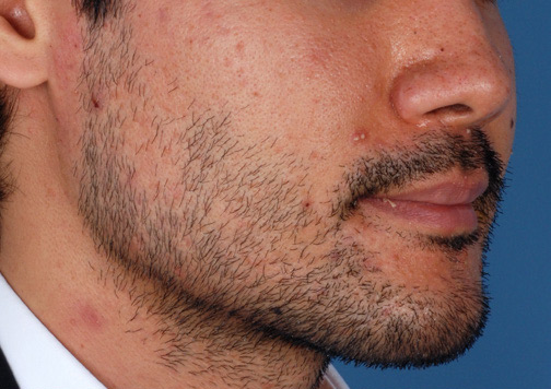 Patient 3 before photo of Rosacea patient at Sensational Skin Scottsdale