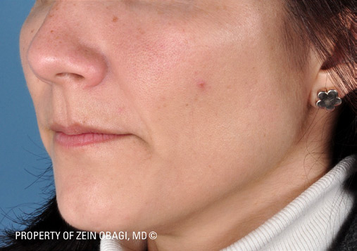 Patient 4 after photo of Rosacea patient at Sensational Skin Scottsdale