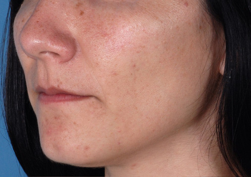 Patient 4 before photo of Rosacea patient at Sensational Skin Scottsdale