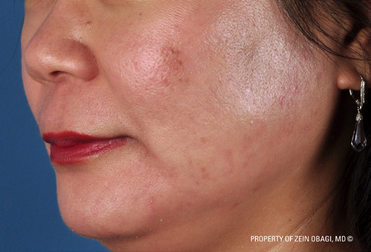 Patient 16 after photo of Acne Scars patient at Sensational Skin Scottsdale