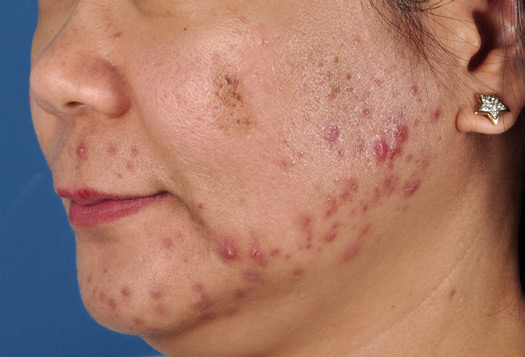 Patient 16 before photo of Acne Scars patient at Sensational Skin Scottsdale