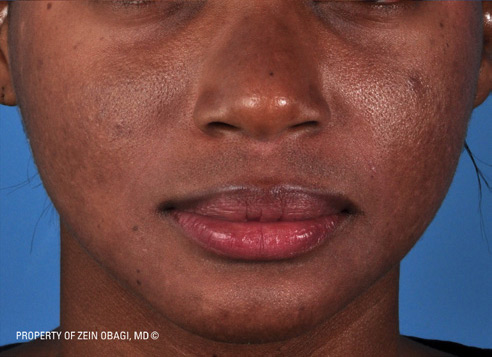 Patient 11 after photo of Acne Scars patient at Sensational Skin Scottsdale