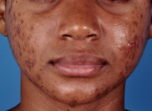 Patient 11 before photo of Acne Scars patient at Sensational Skin Scottsdale