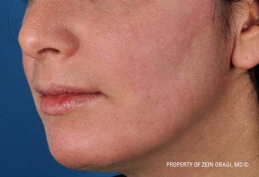 Patient 14 after photo of Acne Scars patient at Sensational Skin Scottsdale