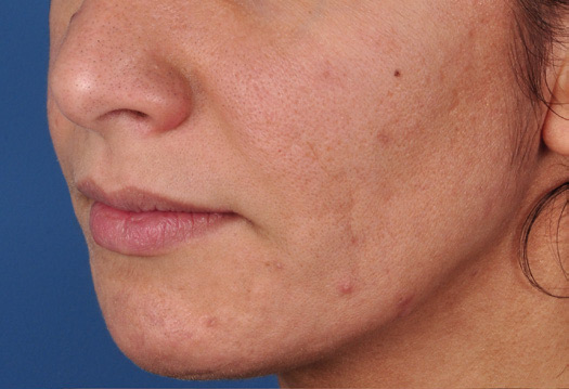 Patient 14 before photo of Acne Scars patient at Sensational Skin Scottsdale