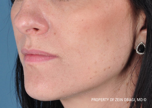 Patient 3 after photo of Sun Damage patient at Sensational Skin Scottsdale