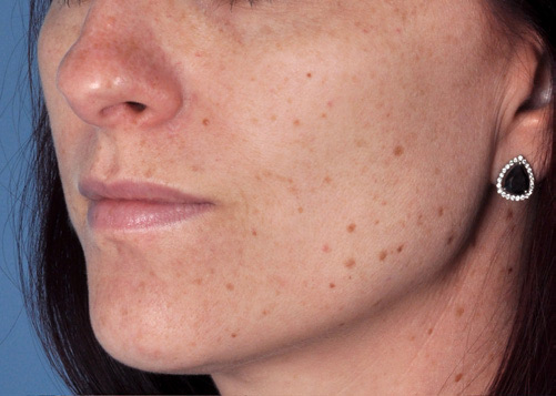 Patient 3 before photo of Sun Damage patient at Sensational Skin Scottsdale