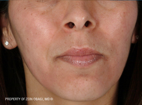 Patient 4 after photo of Sun Damage patient at Sensational Skin Scottsdale