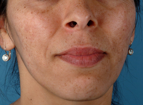 Patient 4 before photo of Sun Damage patient at Sensational Skin Scottsdale