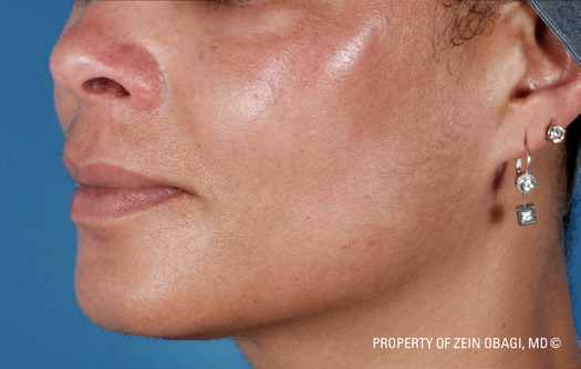 Patient 6 after photo of Sun Damage patient at Sensational Skin Scottsdale