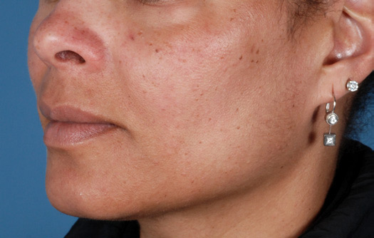 Patient 6 before photo of Sun Damage patient at Sensational Skin Scottsdale
