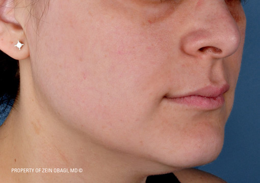 Patient 7 after photo of Sun Damage patient at Sensational Skin Scottsdale