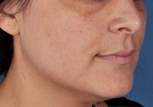 Patient 7 before photo of Sun Damage patient at Sensational Skin Scottsdale
