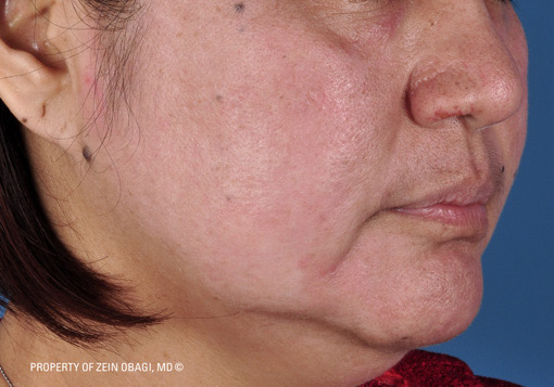 Patient 8 after photo of Sun Damage patient at Sensational Skin Scottsdale