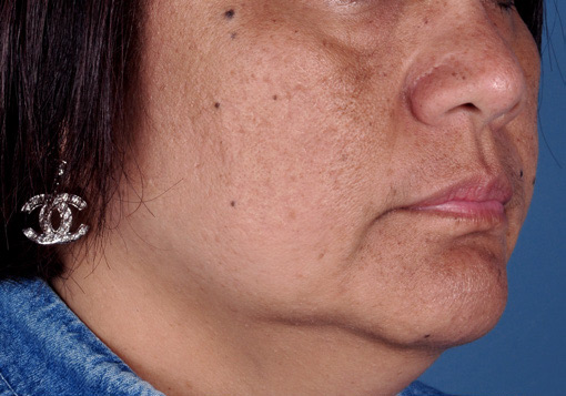 Patient 8 before photo of Sun Damage patient at Sensational Skin Scottsdale