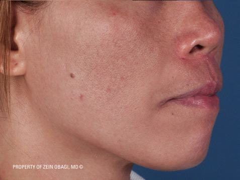 Patient 3 after photo of Melasma patient at Sensational Skin Scottsdale