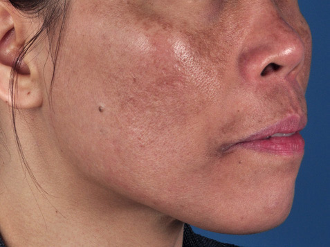 Patient 3 before photo of Melasma patient at Sensational Skin Scottsdale