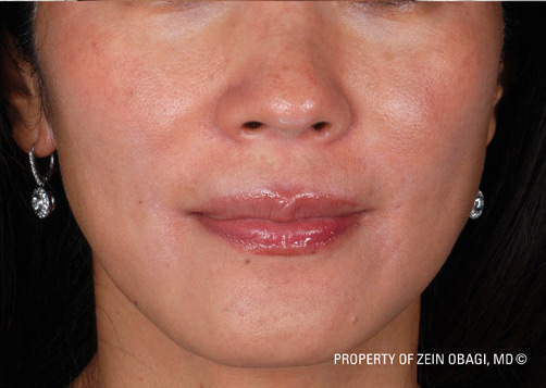 Patient 48 after photo of ZO Skin Health patient at Sensational Skin Scottsdale