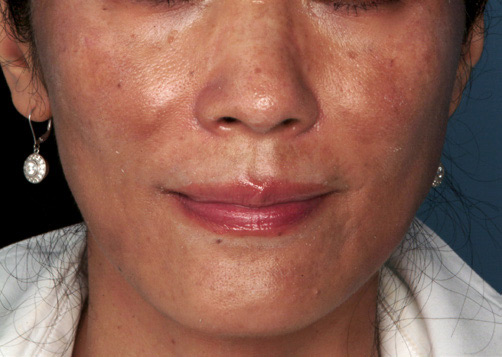 Patient 48 before photo of ZO Skin Health patient at Sensational Skin Scottsdale
