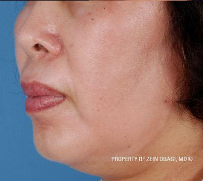 Patient 5 after photo of Melasma patient at Sensational Skin Scottsdale