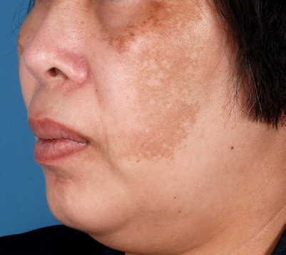 Patient 5 before photo of Melasma patient at Sensational Skin Scottsdale