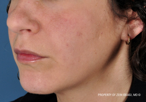 Patient 9 after photo of Sun Damage patient at Sensational Skin Scottsdale