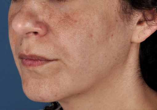 Patient 9 before photo of Sun Damage patient at Sensational Skin Scottsdale