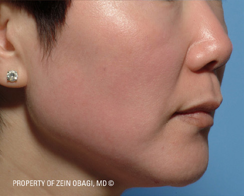 Patient 6 after photo of Melasma patient at Sensational Skin Scottsdale
