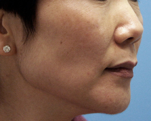 Patient 6 before photo of Melasma patient at Sensational Skin Scottsdale