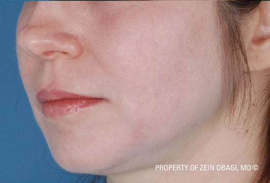 Patient 3 after photo of Large Pores patient at Sensational Skin Scottsdale
