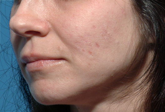 Patient 3 before photo of Large Pores patient at Sensational Skin Scottsdale
