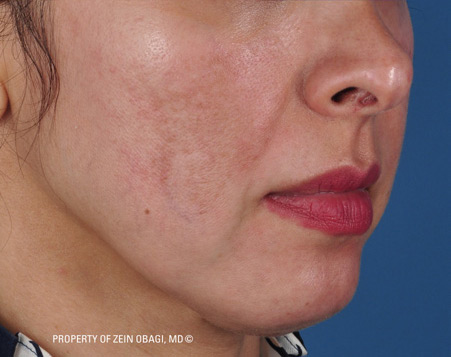Patient 7 after photo of Melasma patient at Sensational Skin Scottsdale