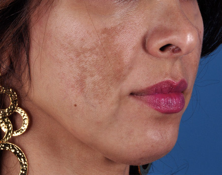 Patient 7 before photo of Melasma patient at Sensational Skin Scottsdale
