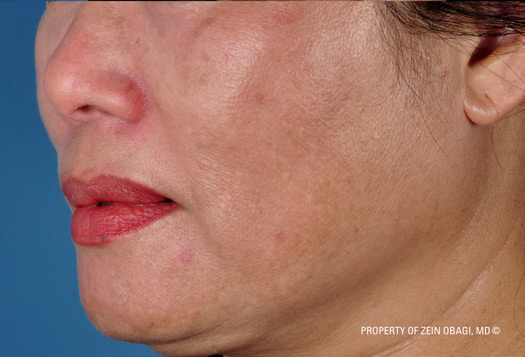 Patient 8 after photo of Melasma patient at Sensational Skin Scottsdale