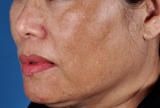 Patient 8 before photo of Melasma patient at Sensational Skin Scottsdale