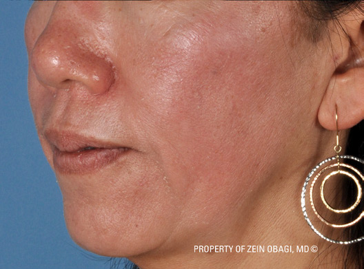 Patient 9 after photo of Melasma patient at Sensational Skin Scottsdale