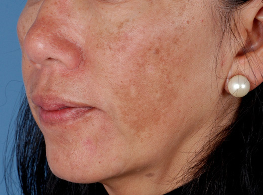 Patient 9 before photo of Melasma patient at Sensational Skin Scottsdale
