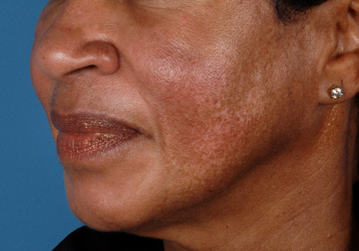 Patient 10 before photo of Melasma patient at Sensational Skin Scottsdale