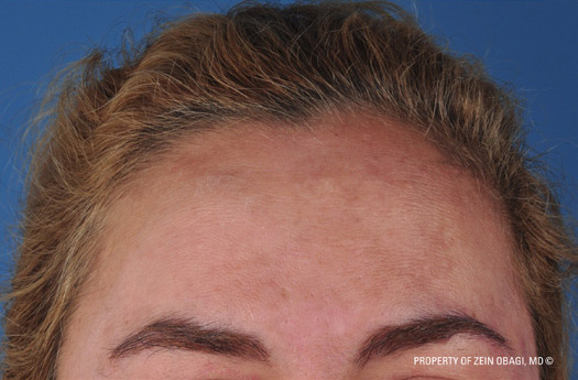 Patient 5 after photo of Rosacea patient at Sensational Skin Scottsdale