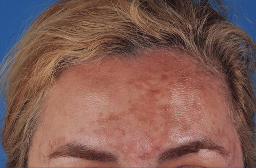 Patient 5 before photo of Rosacea patient at Sensational Skin Scottsdale