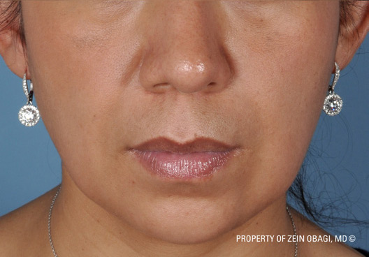 Patient 13 after photo of Melasma patient at Sensational Skin Scottsdale